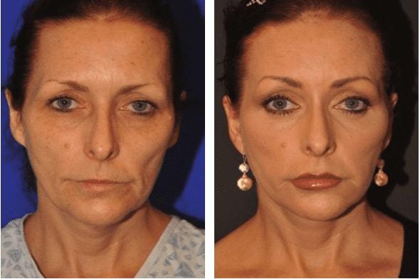 Pasadena Plastic Surgery (Michael Schwartz, MD) facelift result — Pasadena, CA