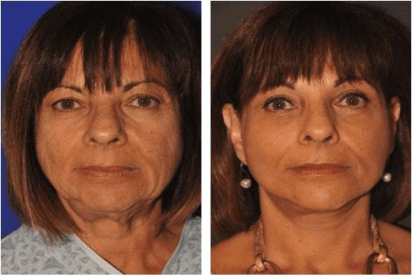 Pasadena Plastic Surgery (Michael Schwartz, MD) facelift result — Pasadena, CA