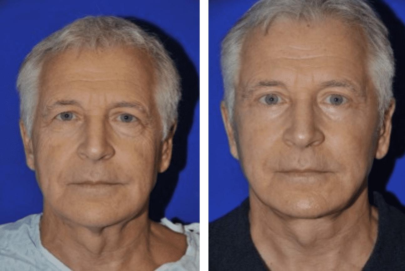 Pasadena Plastic Surgery (Michael Schwartz, MD) facelift result — Pasadena, CA