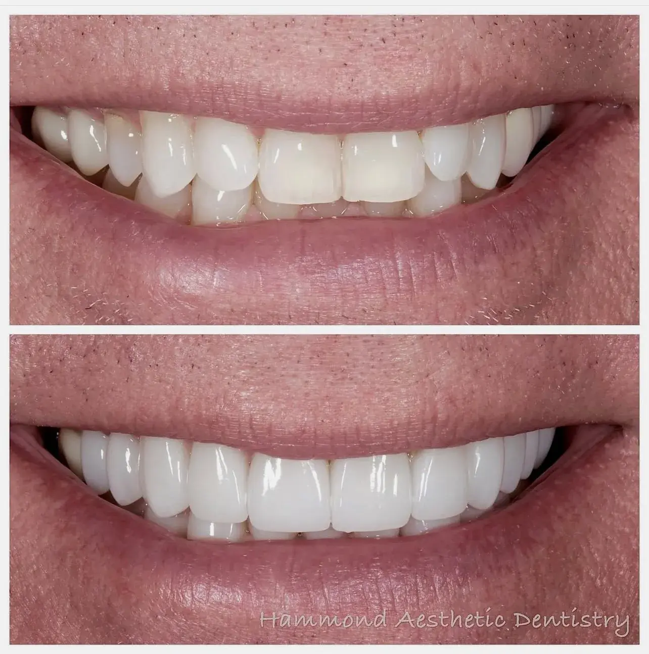 Hammond Aesthetic & General Dentistry result — Provo, UT