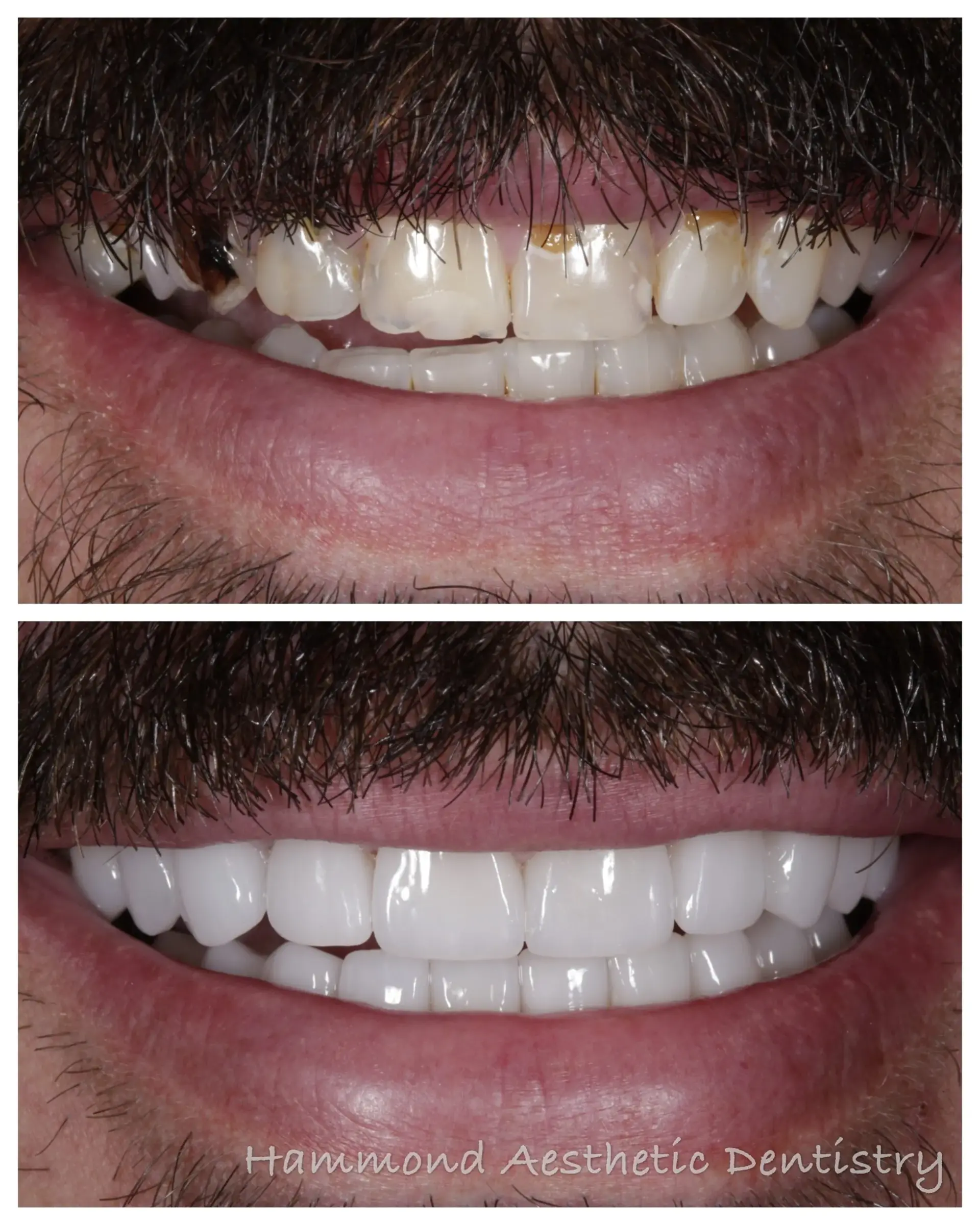 Hammond Aesthetic & General Dentistry result — Provo, UT