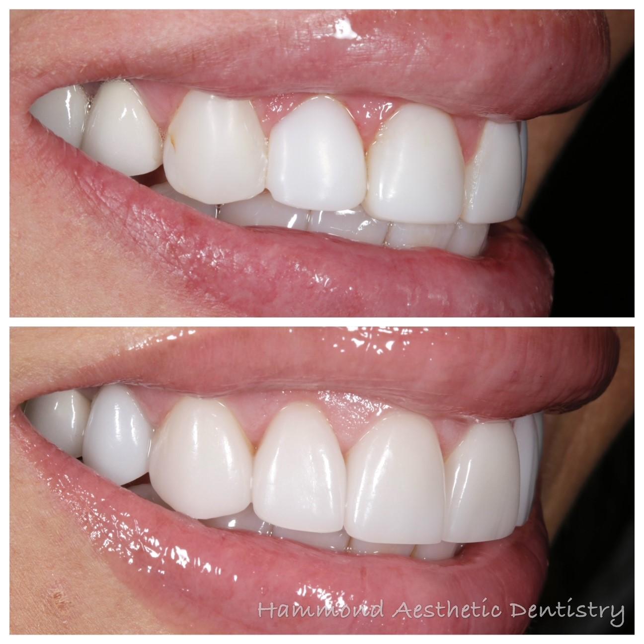 Hammond Aesthetic & General Dentistry result — Provo, UT