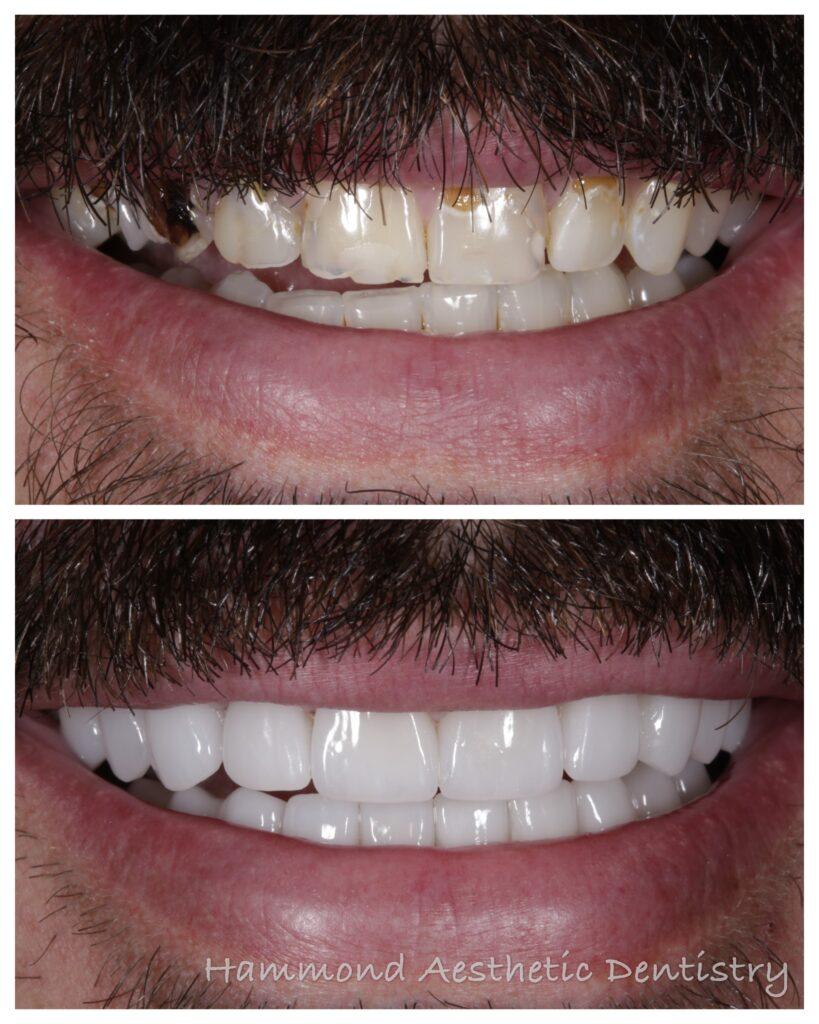 Hammond Aesthetic & General Dentistry result — Provo, UT