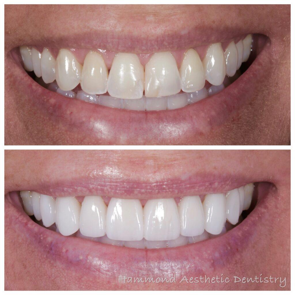 Hammond Aesthetic & General Dentistry result — Provo, UT