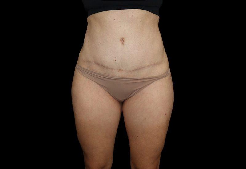 Beverly Hills Plastic Surgery (Gabriel Chiu, MD) tummy tuck after — Beverly Hills, CA