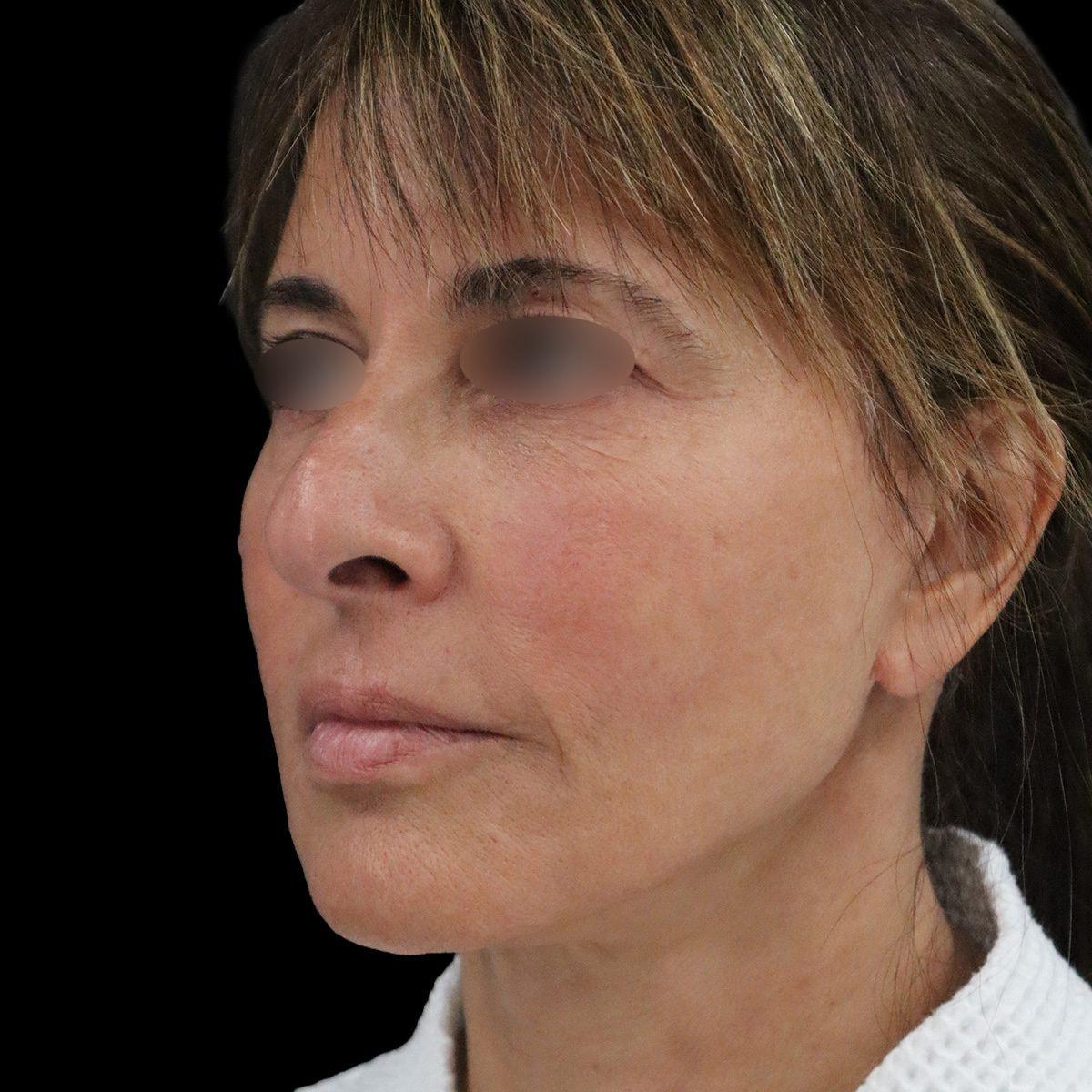 Beverly Hills Plastic Surgery (Gabriel Chiu, MD) facelift after — Beverly Hills, CA