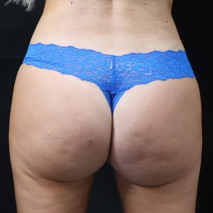 Beverly Hills Plastic Surgery (Gabriel Chiu, MD) bbl after — Beverly Hills, CA