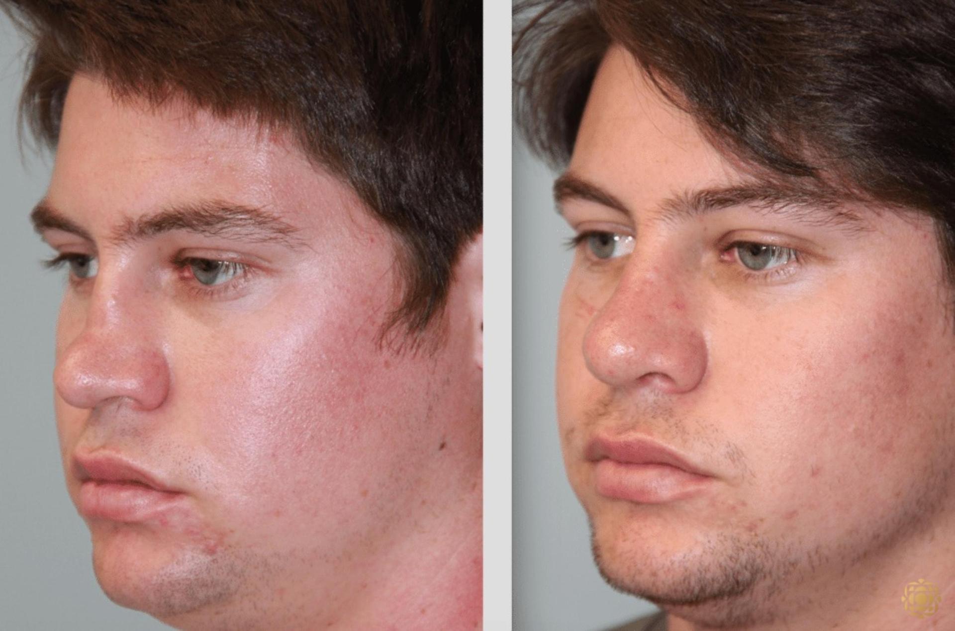 Daines Plastic Surgery: Steven M. Daines, MD FACS rhinoplasty result — Newport Beach, CA