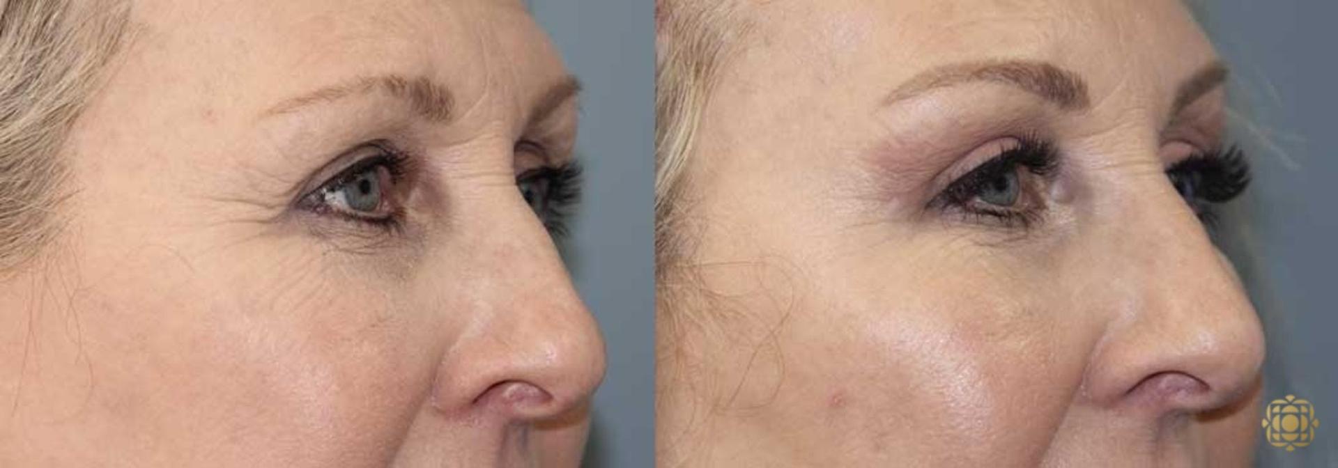 Daines Plastic Surgery: Steven M. Daines, MD FACS brow lift result — Newport Beach, CA