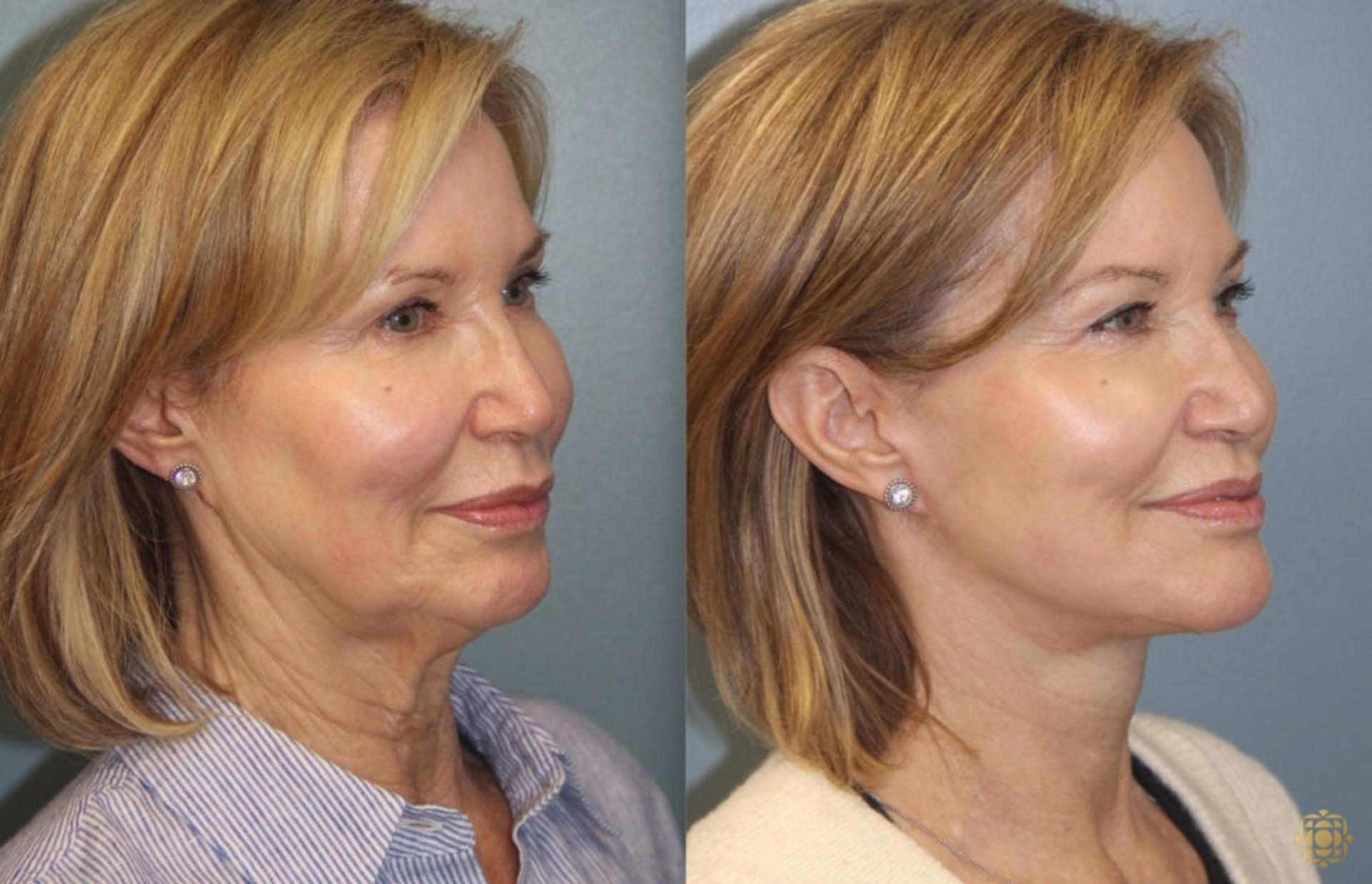 Daines Plastic Surgery: Steven M. Daines, MD FACS facelift result — Newport Beach, CA