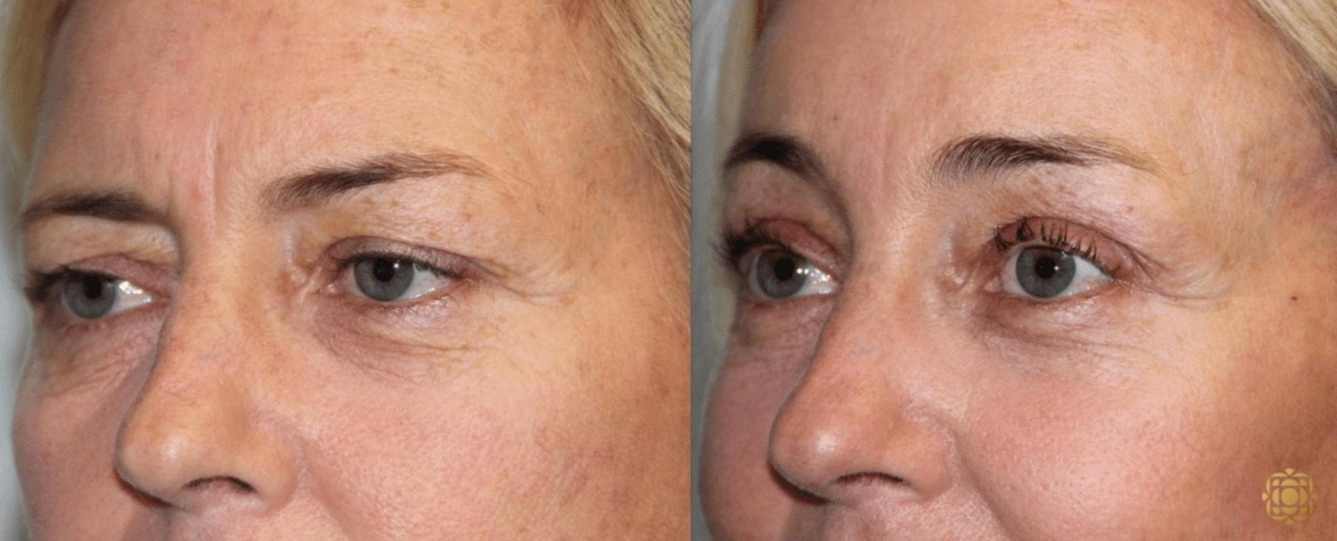 Daines Plastic Surgery: Steven M. Daines, MD FACS brow lift result — Newport Beach, CA