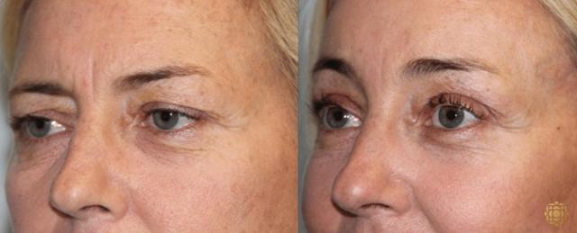 Brow Lift result at Daines Plastic Surgery: Steven M. Daines, MD FACS in Newport Beach, CA