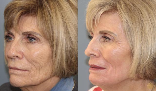 Laser Skin Resurfacing result at Daines Plastic Surgery: Steven M. Daines, MD FACS in Newport Beach, CA