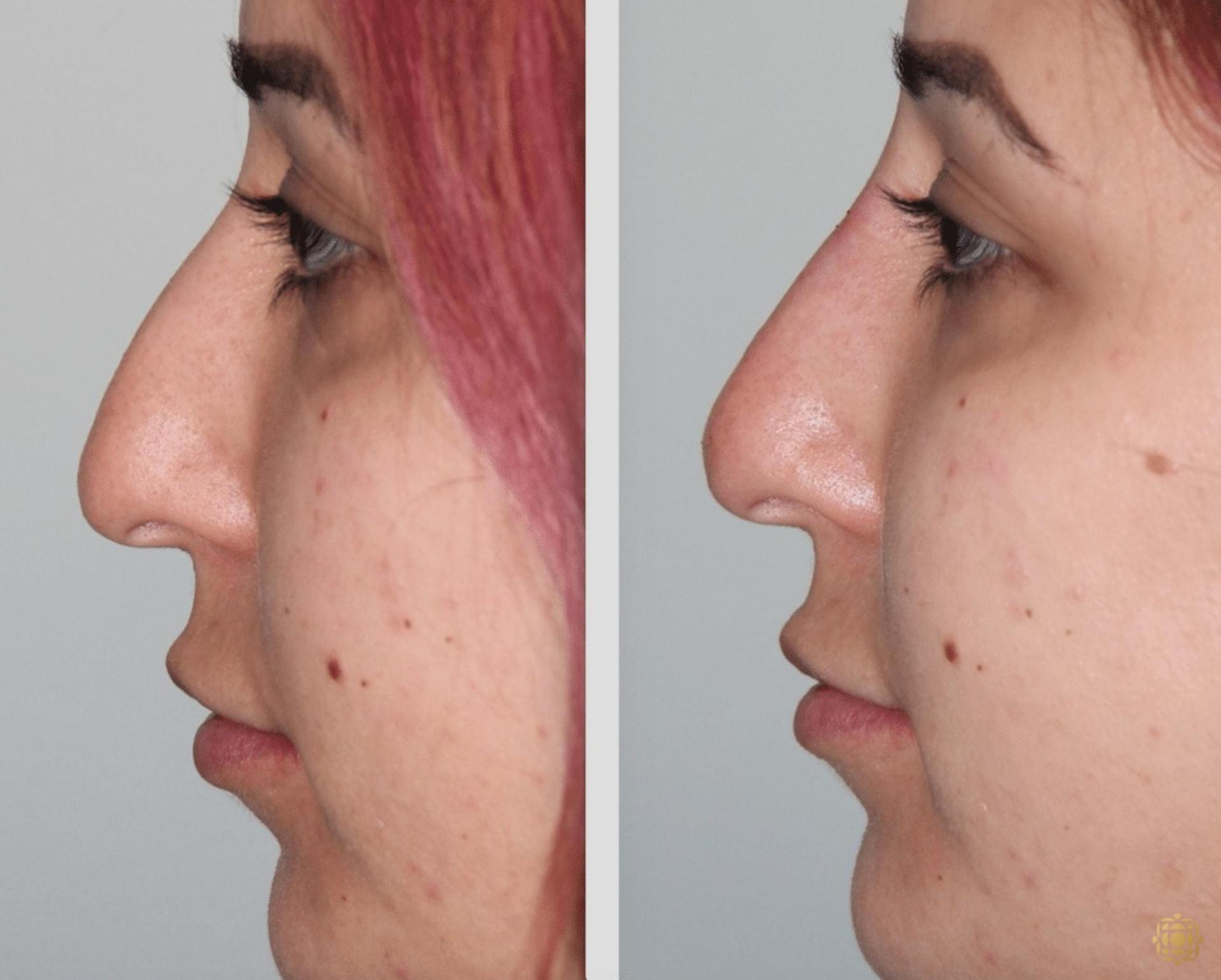 Daines Plastic Surgery: Steven M. Daines, MD FACS rhinoplasty result — Newport Beach, CA