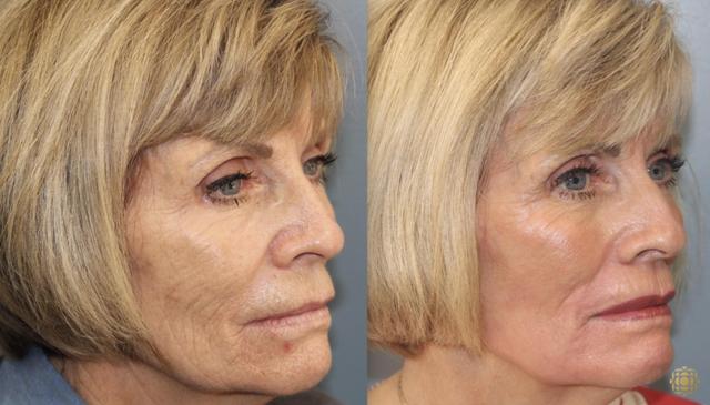 Laser Skin Resurfacing result at Daines Plastic Surgery: Steven M. Daines, MD FACS in Newport Beach, CA