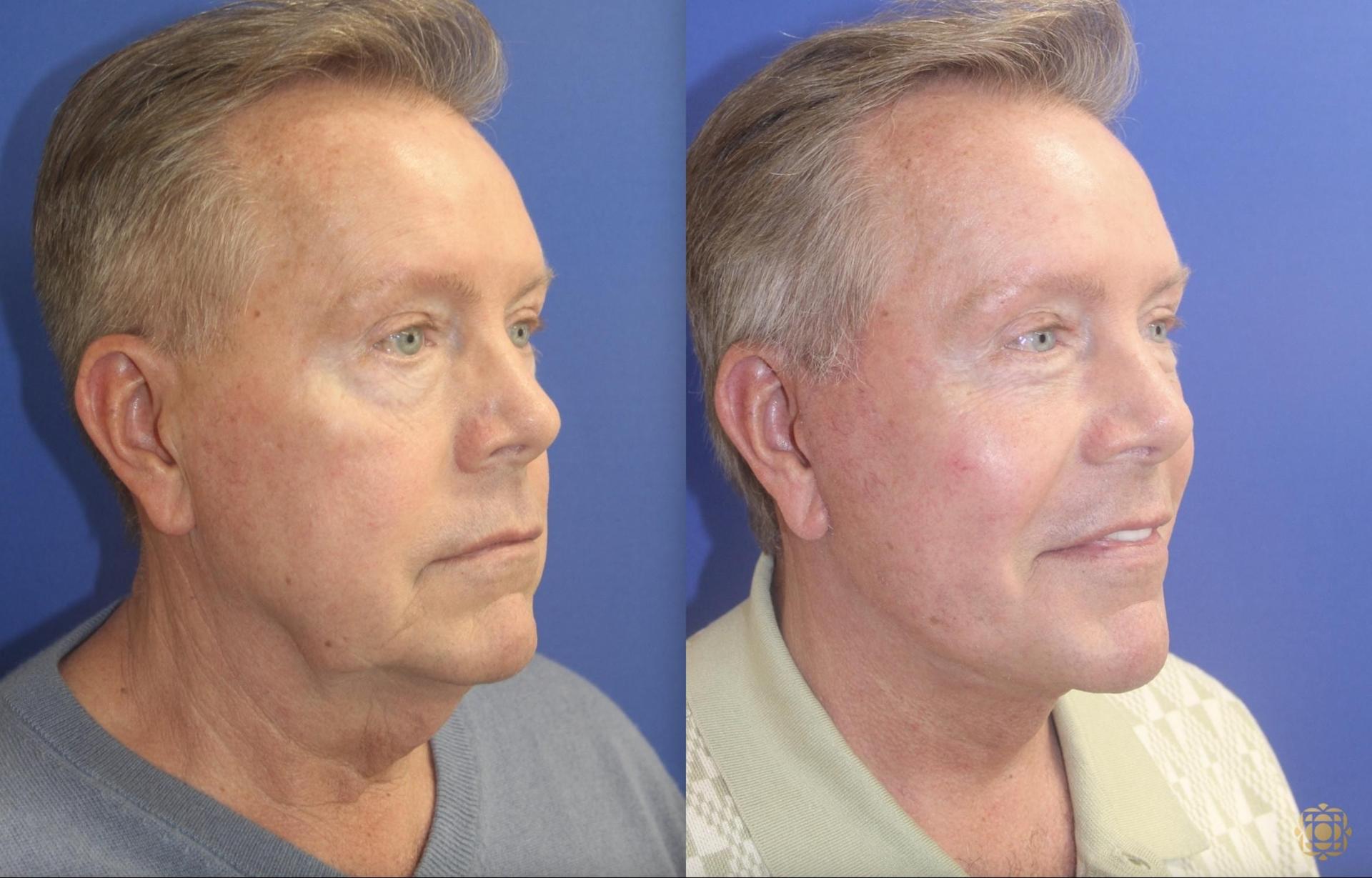 Daines Plastic Surgery: Steven M. Daines, MD FACS facelift result — Newport Beach, CA