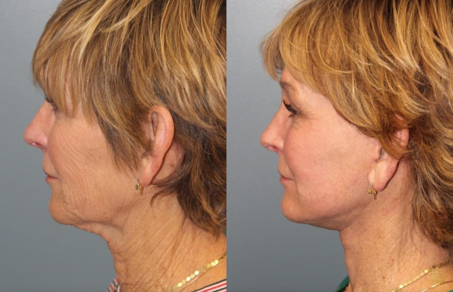 Daines Plastic Surgery: Steven M. Daines, MD FACS facelift result — Newport Beach, CA