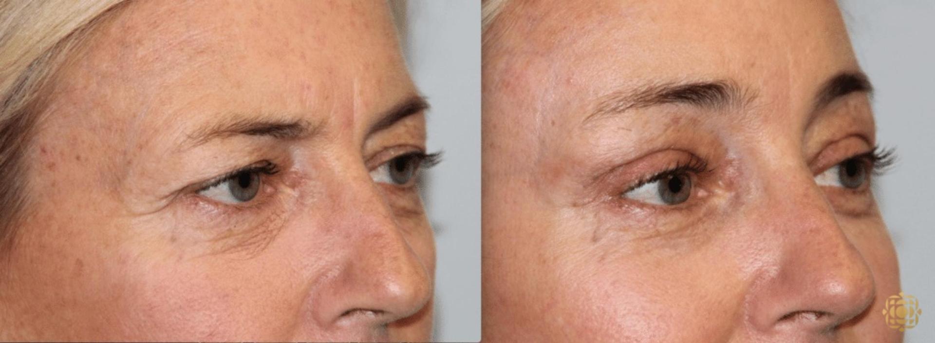 Daines Plastic Surgery: Steven M. Daines, MD FACS brow lift result — Newport Beach, CA