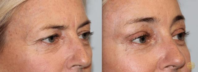 Brow Lift result at Daines Plastic Surgery: Steven M. Daines, MD FACS in Newport Beach, CA