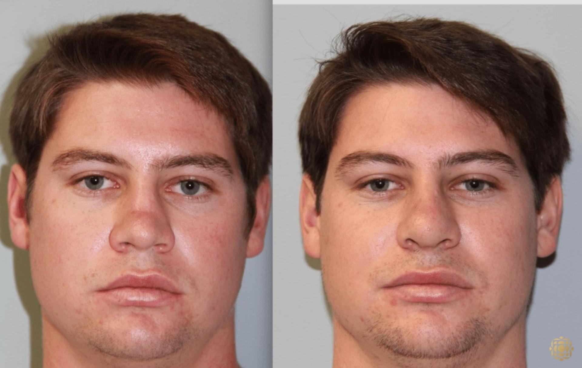 Daines Plastic Surgery: Steven M. Daines, MD FACS rhinoplasty result — Newport Beach, CA