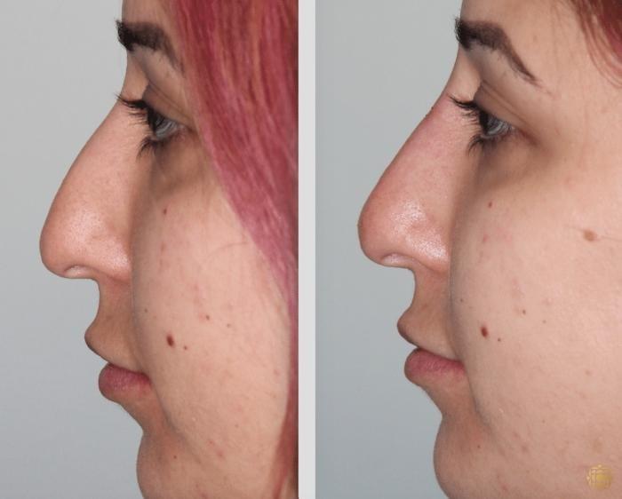 Daines Plastic Surgery: Steven M. Daines, MD FACS rhinoplasty result — Newport Beach, CA