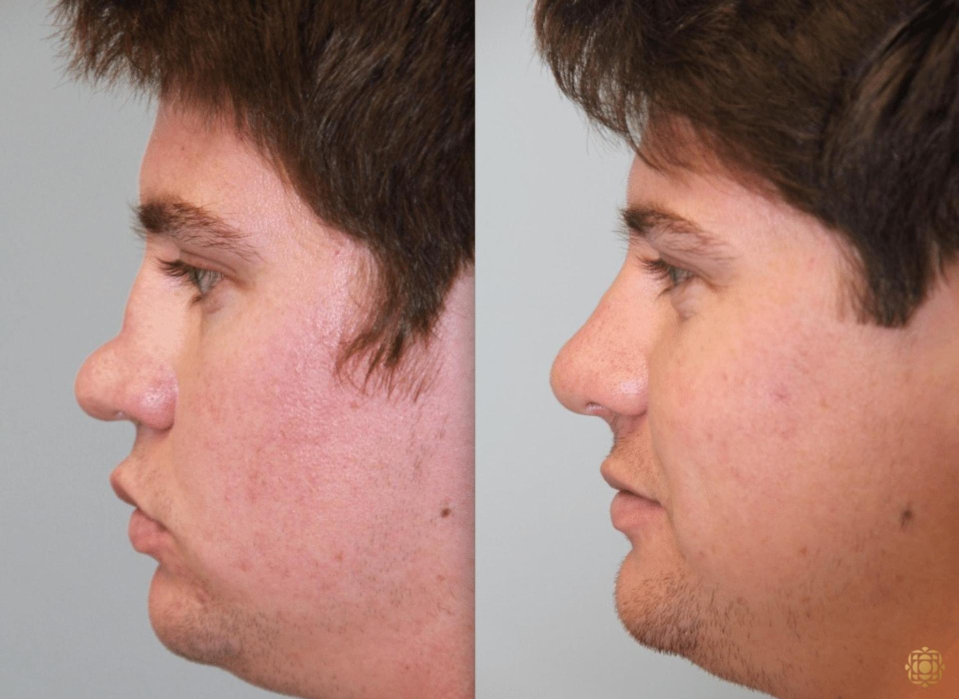 Daines Plastic Surgery: Steven M. Daines, MD FACS rhinoplasty result — Newport Beach, CA