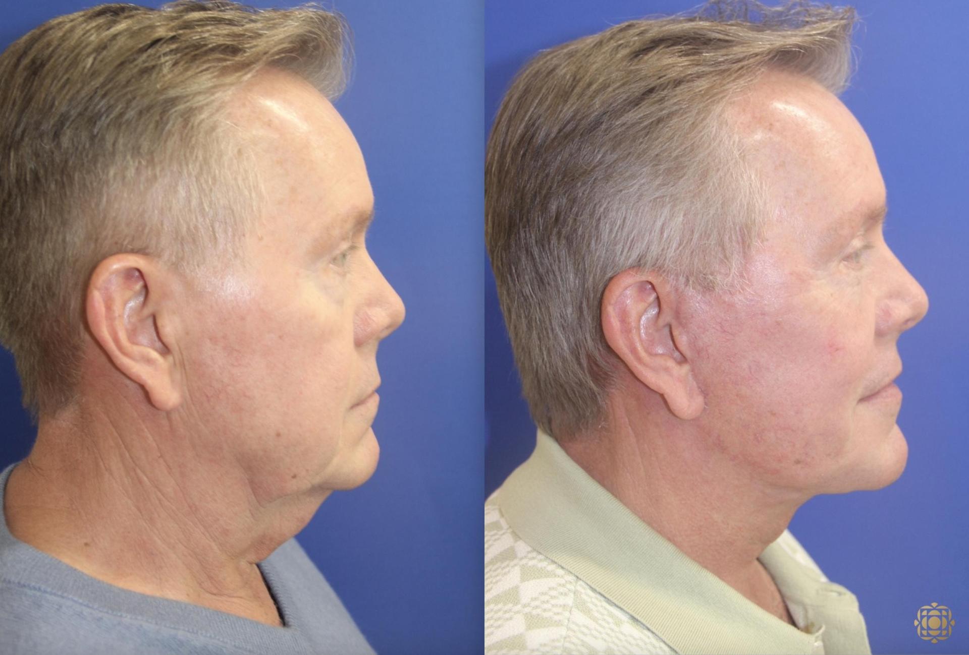 Daines Plastic Surgery: Steven M. Daines, MD FACS facelift result — Newport Beach, CA