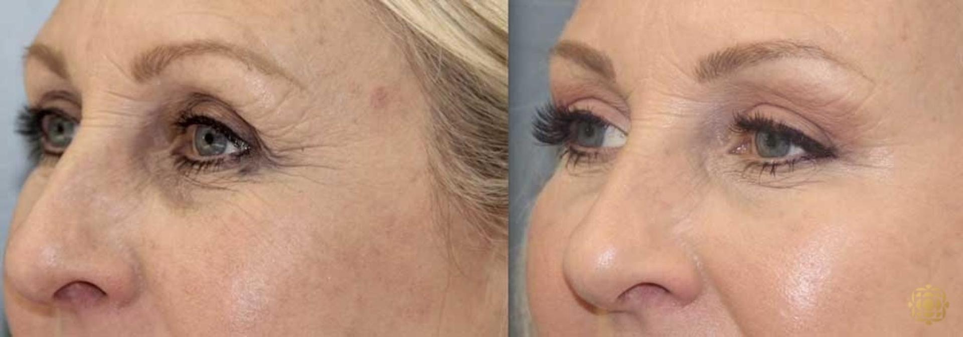 Daines Plastic Surgery: Steven M. Daines, MD FACS brow lift result — Newport Beach, CA