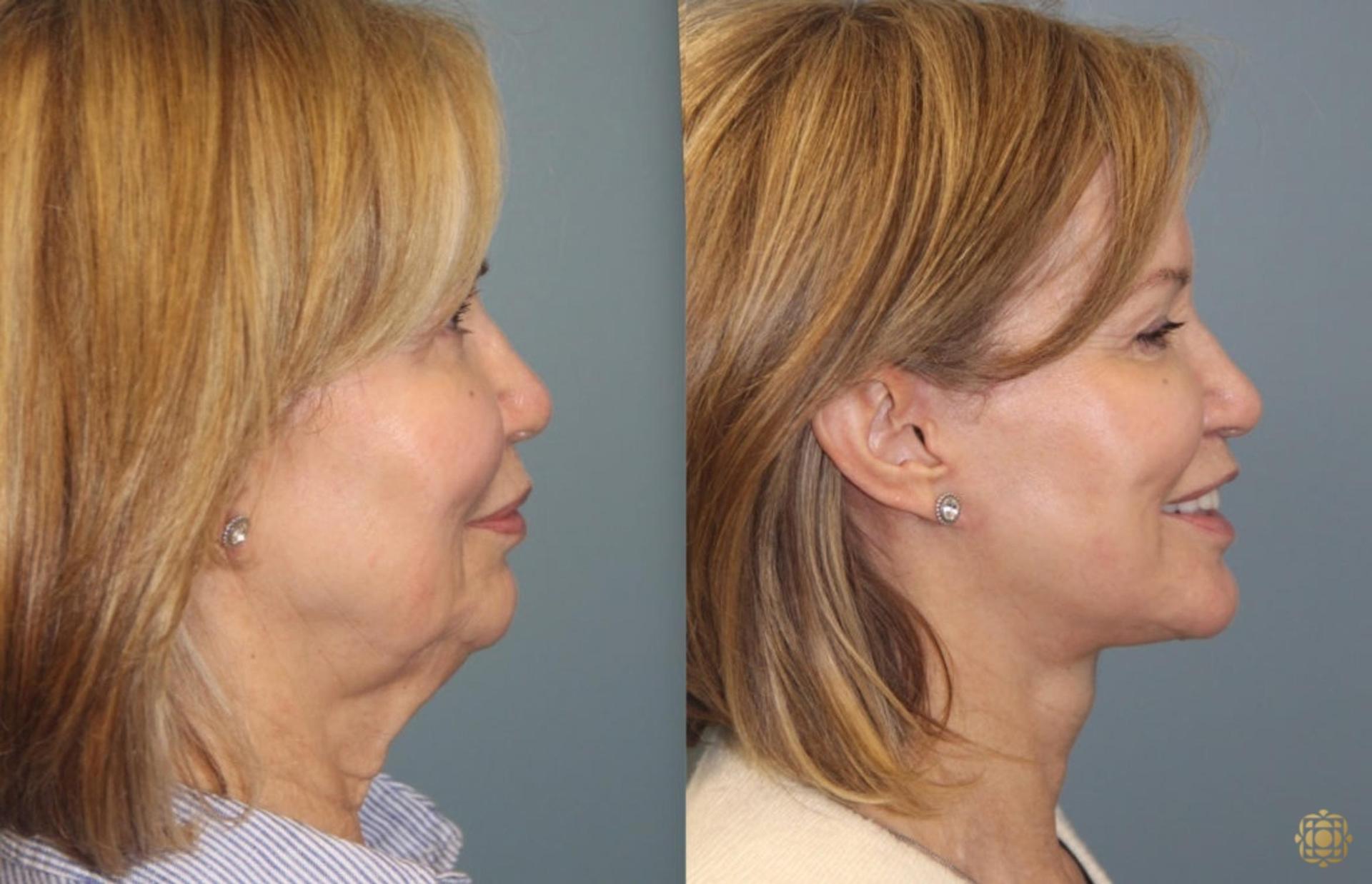 Daines Plastic Surgery: Steven M. Daines, MD FACS facelift result — Newport Beach, CA