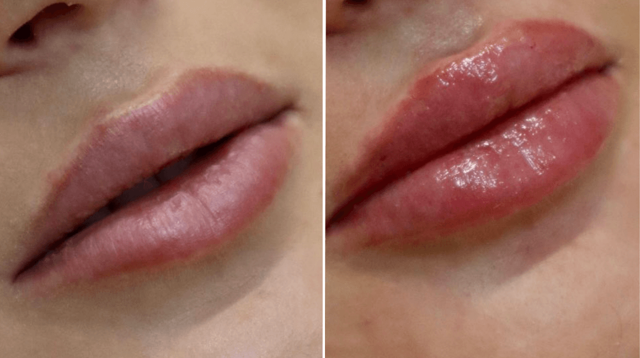 Lip Filler result at PURE Medical Spa in Meridian, ID