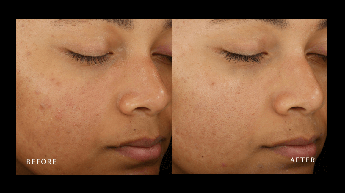 PURE Medical Spa result — Meridian, ID