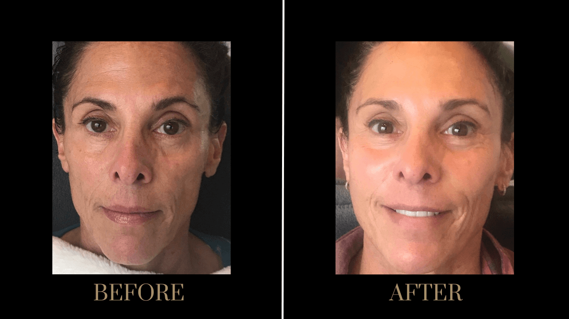 PURE Medical Spa result — Meridian, ID