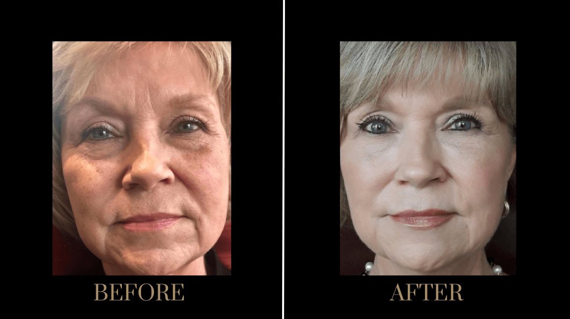 PURE Medical Spa result — Meridian, ID
