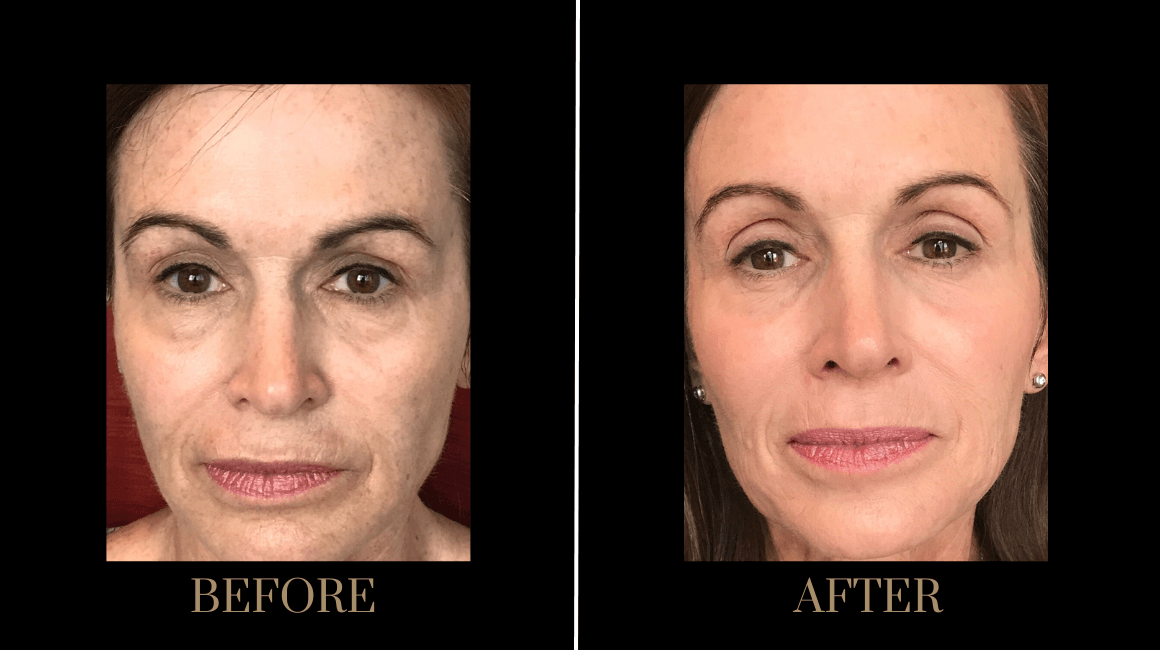 PURE Medical Spa result — Meridian, ID