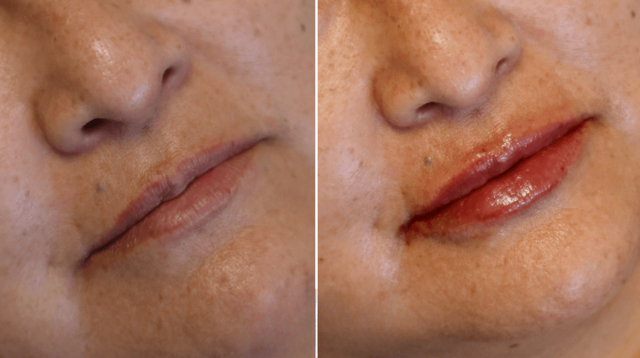 Lip Filler result at PURE Medical Spa in Meridian, ID