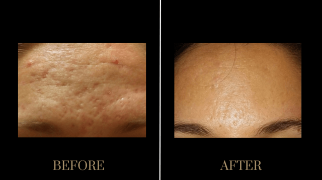 Microneedling result at PURE Medical Spa in Meridian, ID