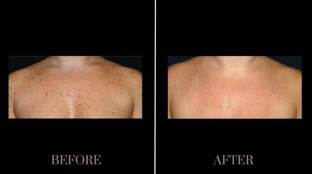 Brazilian Butt Lift result at PURE Medical Spa in Meridian, ID
