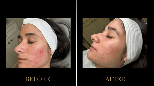 Microneedling result at PURE Medical Spa in Meridian, ID