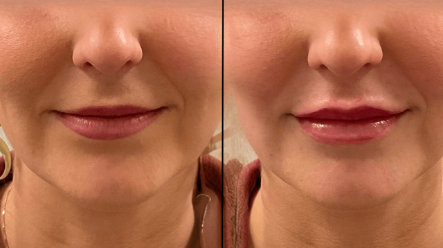 Lip Filler result at PURE Medical Spa in Meridian, ID