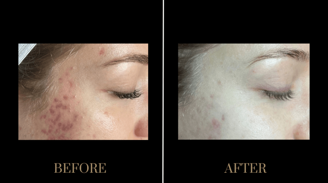 Microneedling result at PURE Medical Spa in Meridian, ID