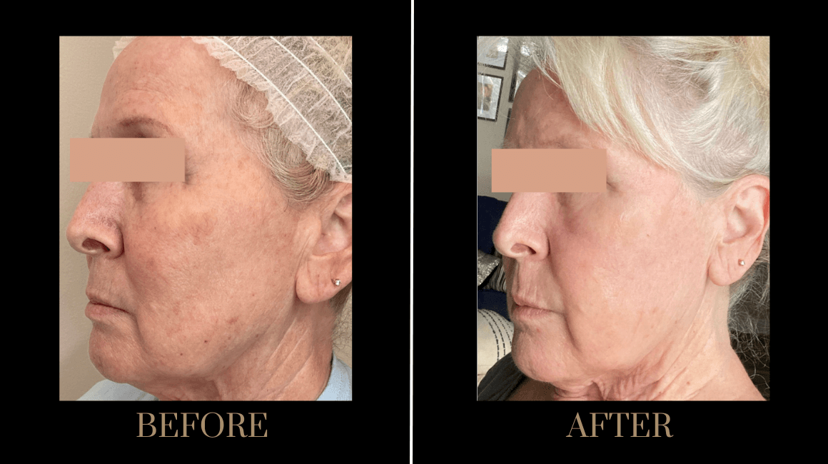 PURE Medical Spa facelift result — Meridian, ID