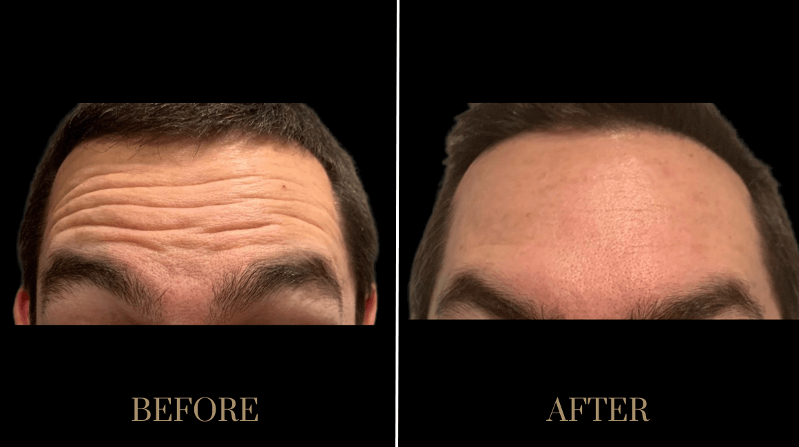 PURE Medical Spa result — Meridian, ID