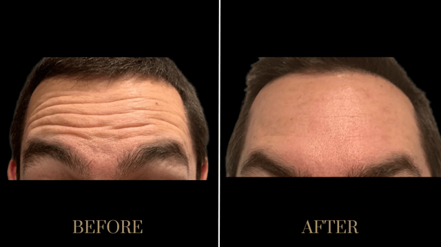 Botox result at PURE Medical Spa in Meridian, ID