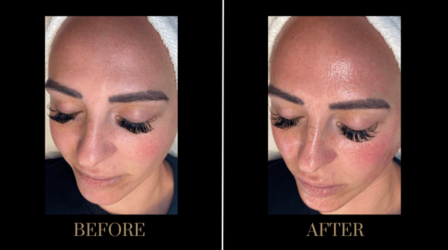 Microneedling result at PURE Medical Spa in Meridian, ID