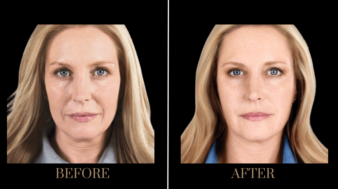 PURE Medical Spa result — Meridian, ID
