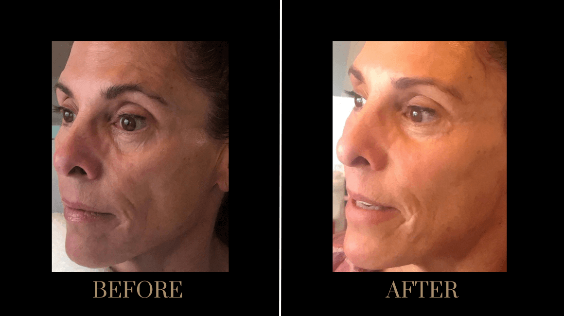 PURE Medical Spa result — Meridian, ID