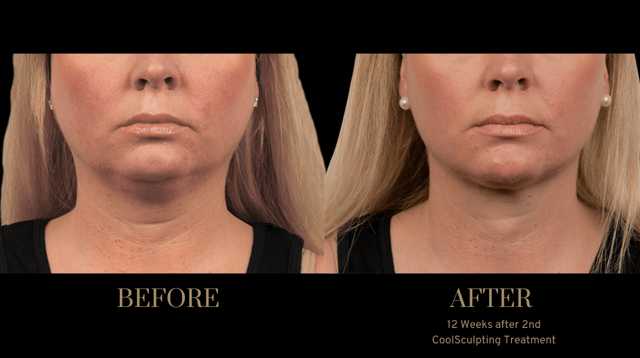CoolSculpting result at PURE Medical Spa in Meridian, ID