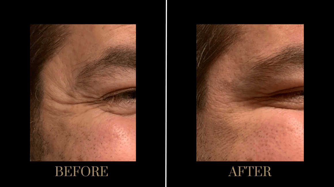 PURE Medical Spa result — Meridian, ID
