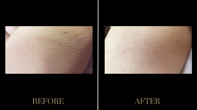 Morpheus8 result at PURE Medical Spa in Meridian, ID