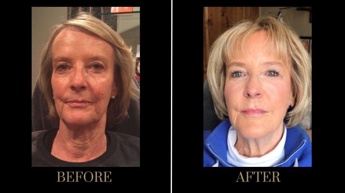 PURE Medical Spa result — Meridian, ID